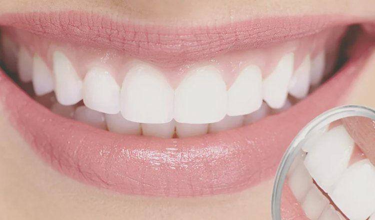 Full Consultation with Teeth Whitening Treatment and Take-Home Kit at Kingswater Dental Practice