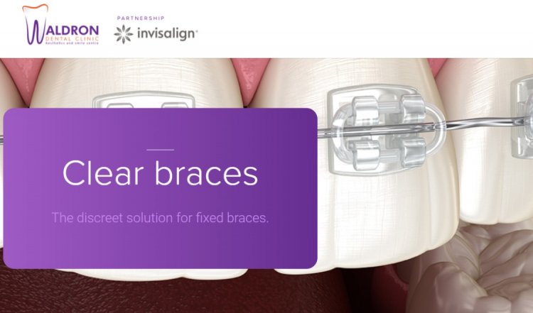 One arc: ceramic clear or metal braces at Waldron Dental Clinic. Only £139 - You saved 75% Off