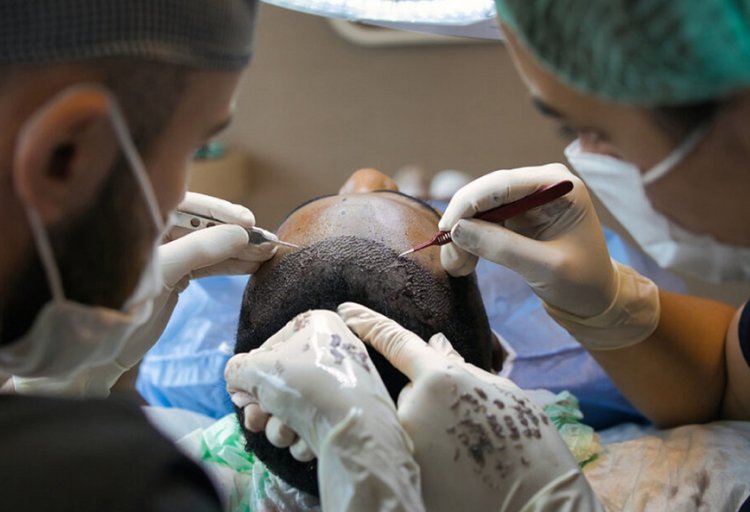Crowning Glory: Turkey's Success in Hair Transplantation Beckons Global Visitors