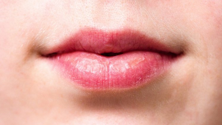 Understanding Lip Fillers: A Comprehensive Guide
