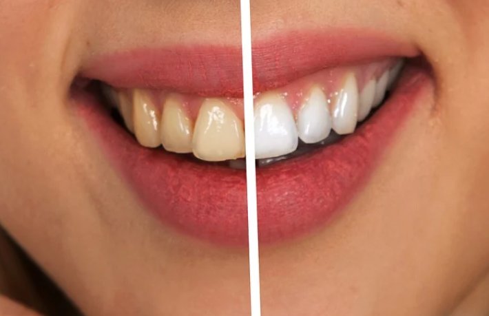 A Guide to Achieving a Brighter Smile: Everything You Need to Know About Teeth Whitening