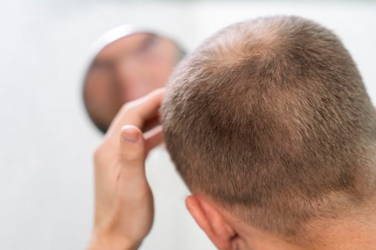 Understanding Hair Loss: Causes, Prevention, and Practical Tips