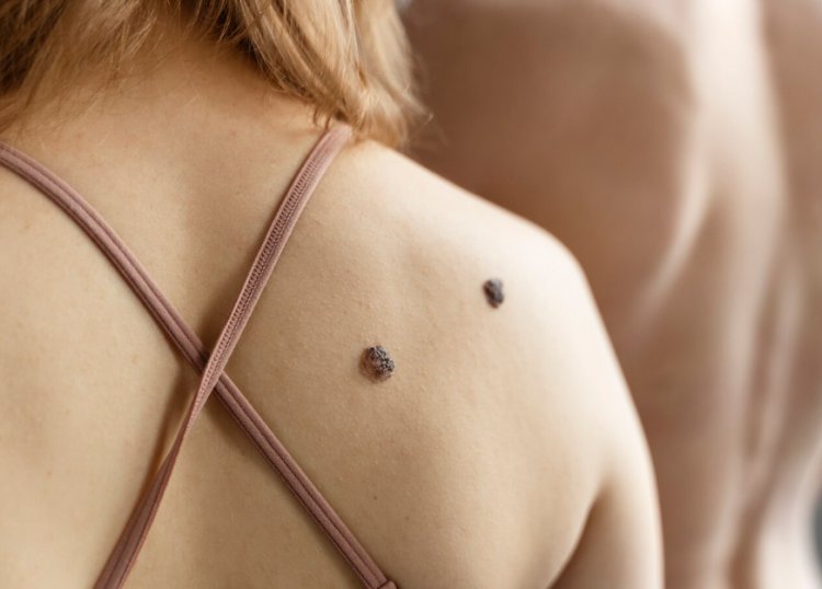Say Goodbye to Skin Tags: The Ultimate Guide to Skin Tag Removal