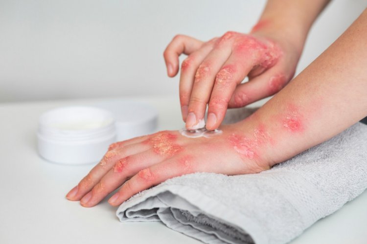 Psoriasis: A Comprehensive Guide to the Chronic Skin Condition