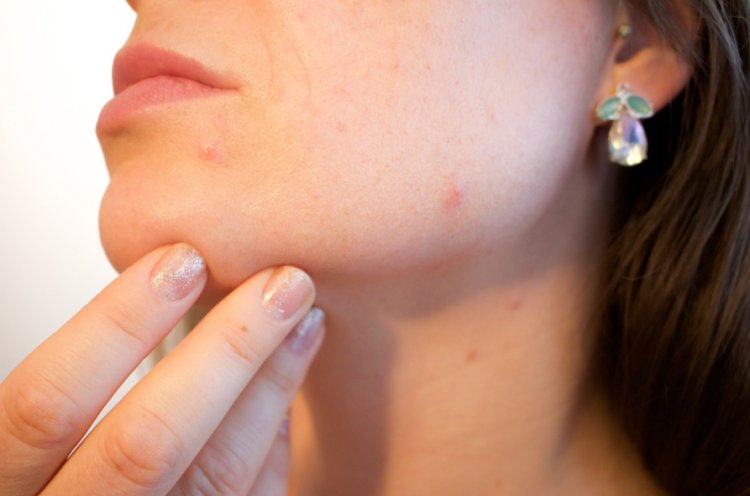 Unveiling Acne: Insights into Causes, Management, and Skincare