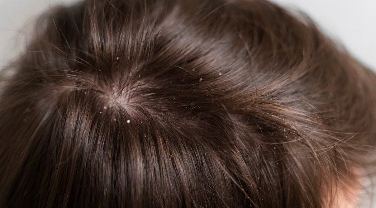 Comprehensive Guide to Understanding Dandruff: Causes, Treatment, and 