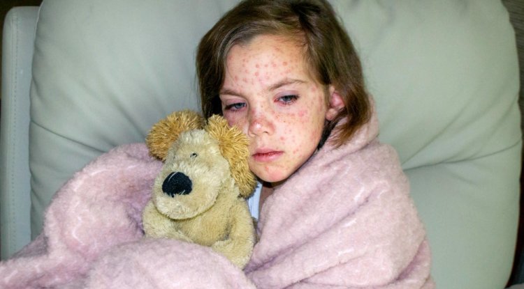 From Chickenpox to Shingles: Understanding the Viral Journey - Coupoly