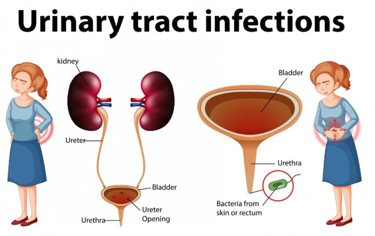  Urinary Tract Infections (UTIs): Causes, Symptoms, and Treatment