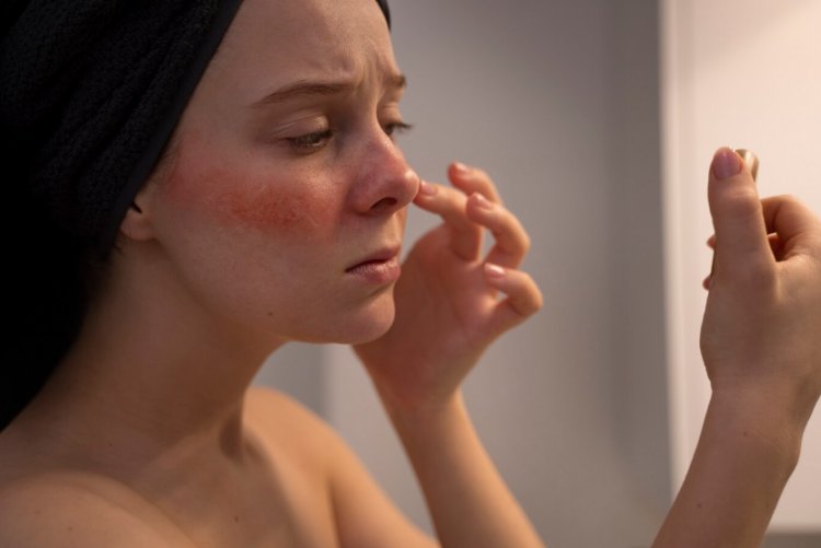 Rosacea: Understanding the Chronic Skin Condition