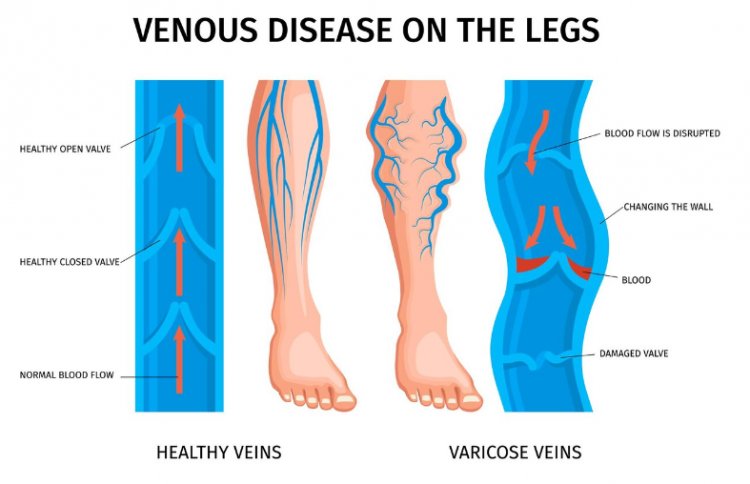 The Complete Guide to Varicose Veins: Causes, Symptoms, and Effective Treatments