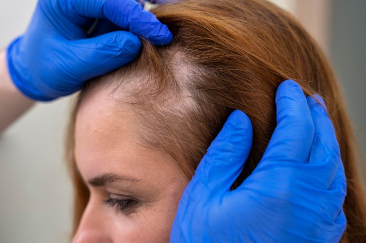 Decoding Alopecia: Unraveling the Mystery of Hair Loss