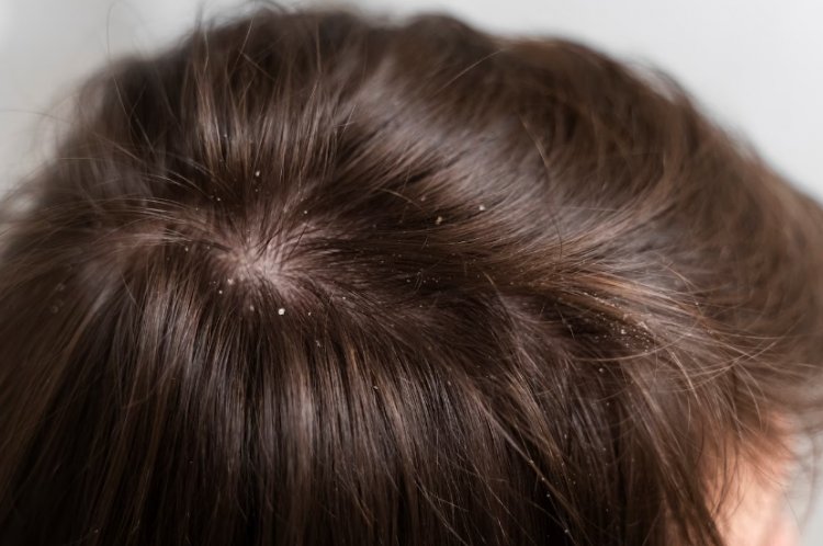 Comprehensive Guide to Understanding Dandruff: Causes, Treatment, and Prevention