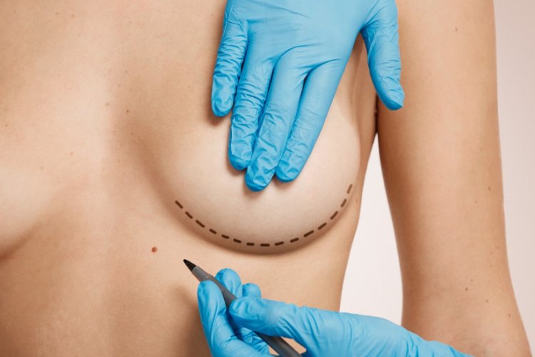 Mamoplasty: A Comprehensive Overview