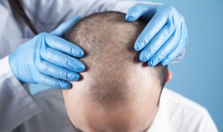 A Comprehensive Overview of Permanent Hair Transplantation Techniques