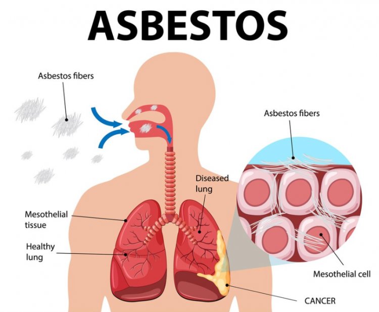 Asbestosis: A Silent Threat