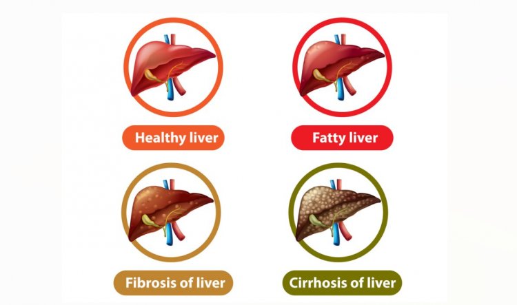 Non-Alcoholic Fatty Liver Disease: Understanding the Silent Epidemic