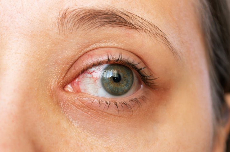 In the Blink of an Eye: Deciphering Blepharitis