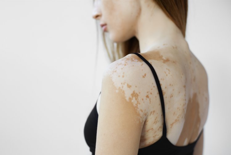 Comprehensive Guide to Vitiligo: Causes, Symptoms, Diagnosis, and Treatment