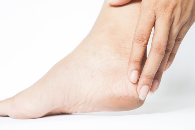  Memory updated Foot Care Essentials: How to Combat and Prevent Cracked Heels