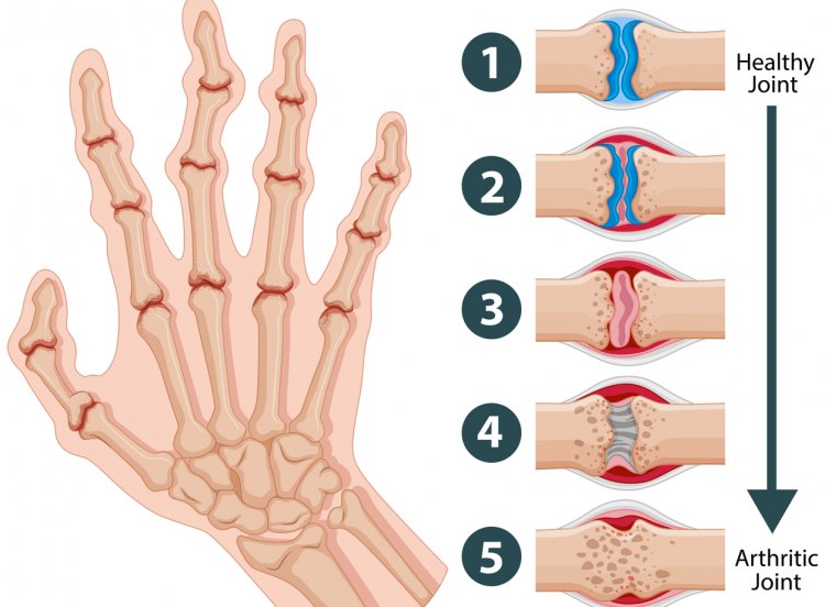 Arthritis: A Comprehensive Guide
