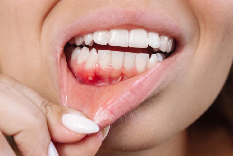 Gum Diseases and Systemic Health: Exploring the Connections