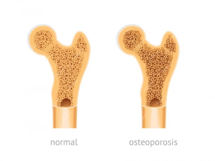 Building Stronger Bones: Strategies to Combat Osteoporosis