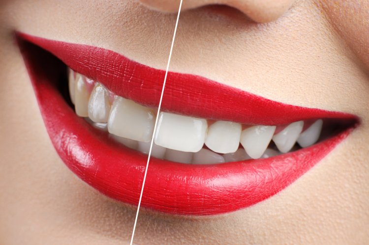 Exploring Teeth Whitening: Types, Procedures, Precautions, and More