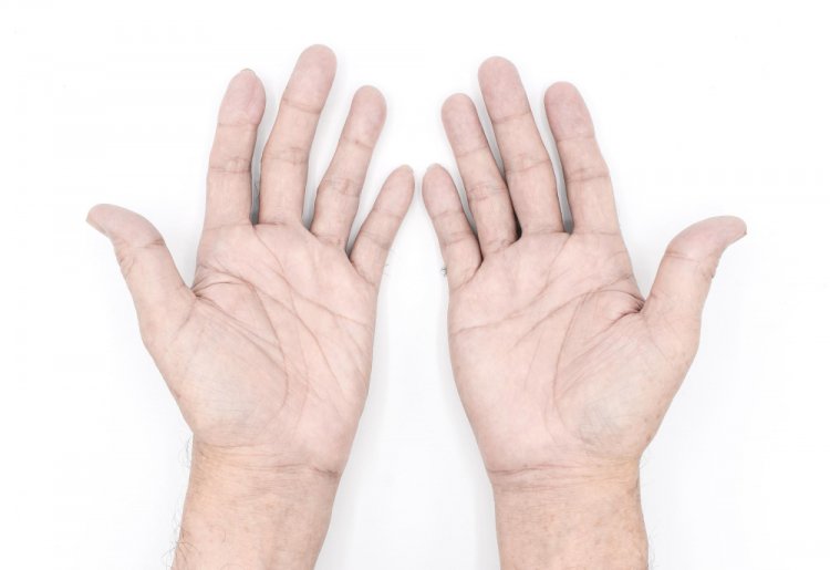 Cold Hands, Warm Solutions: Managing Raynaud's with Ease