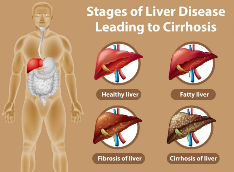 Cirrhosis: Bridging Science and Hope for a Healthier Liver Future