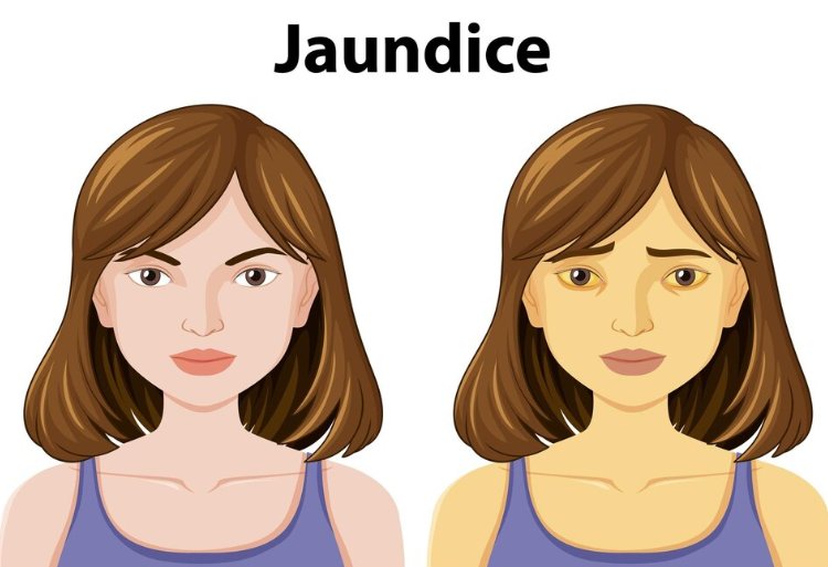 The Yellow Alarm: Recognizing the Signs and Symptoms of Jaundice