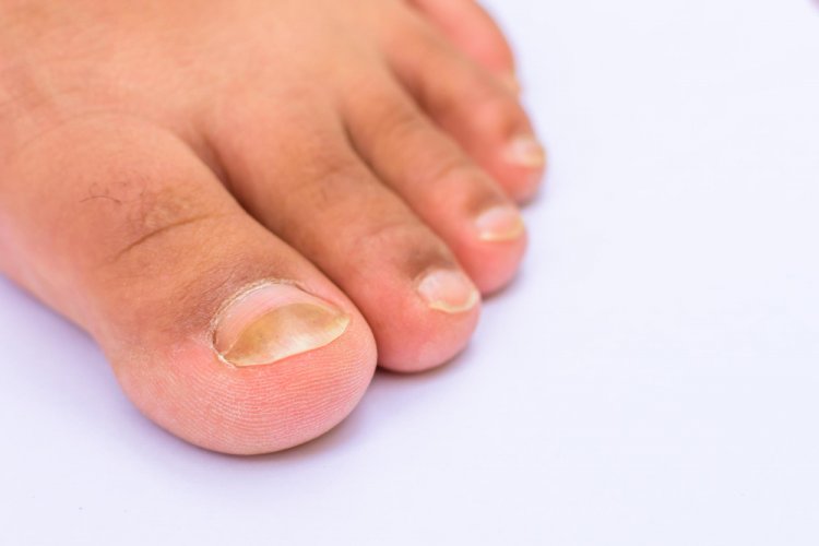 Beyond Aesthetics: The Medical Impact of Fungal Nail Infections