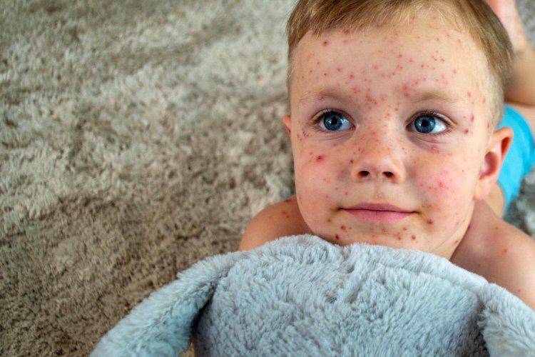 A Closer Look at Common Childhood Viral Infections: Fifth and Sixth Diseases Decoded
