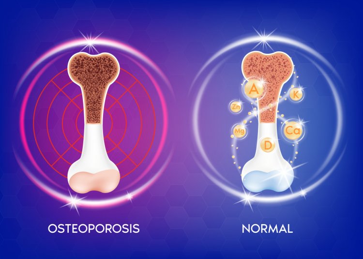 The Bone Balancing Act: Managing Osteopenia for Optimal Health