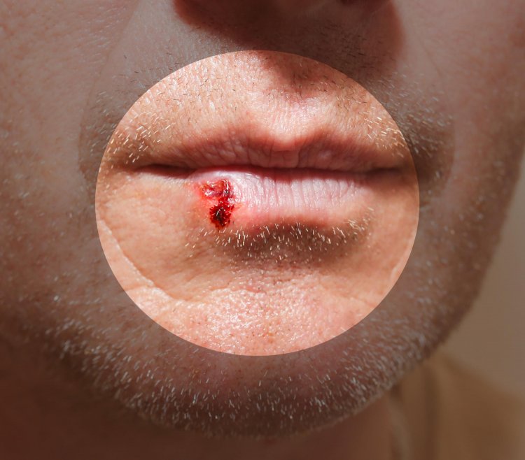 Herpes Zoster: A Closer Look at the Painful Rash