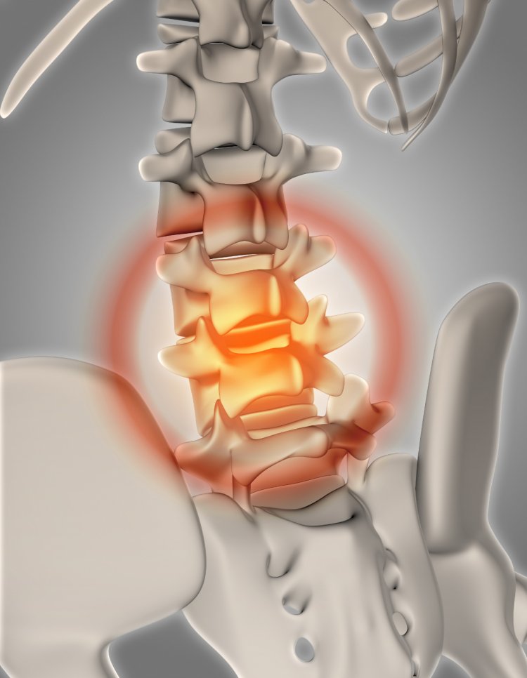 Lumbar Herniated Disc: A Comprehensive Guide to Understanding, Managing, and Preventing