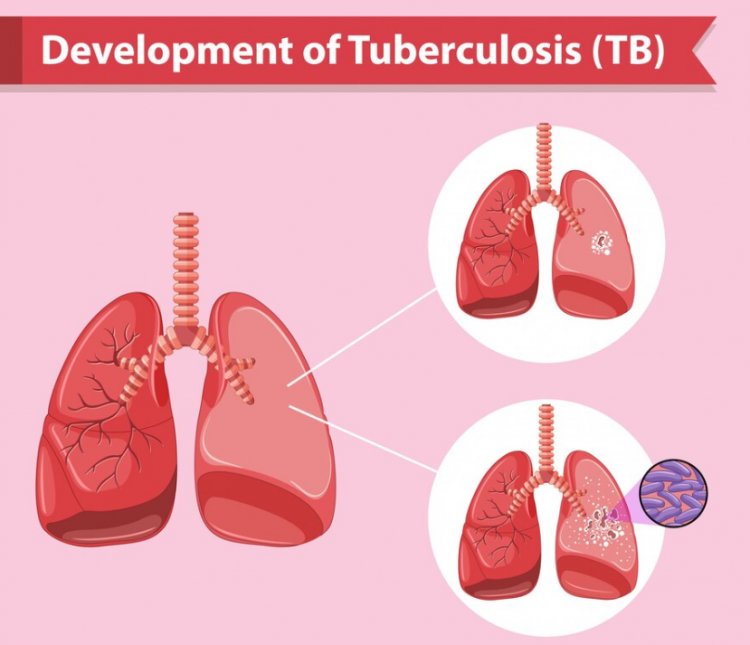 From Past to Present: Tuberculosis in the Modern Era