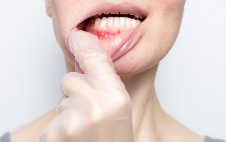 What is Oral Thrush? Symptoms and Treatment