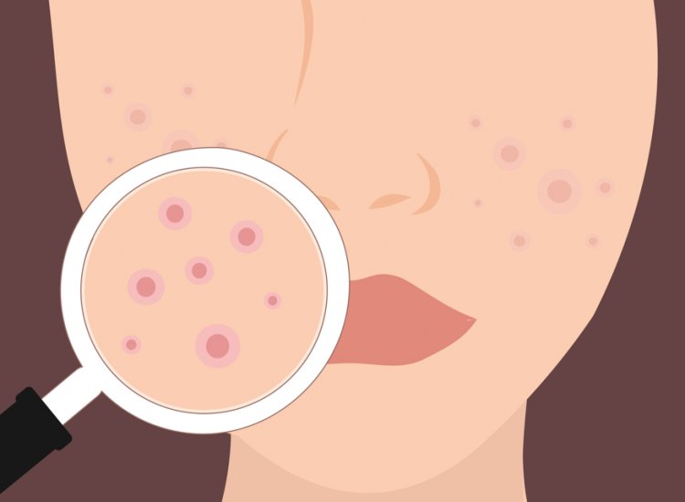 Boils: The Skin's Silent Agony and How to Overcome It