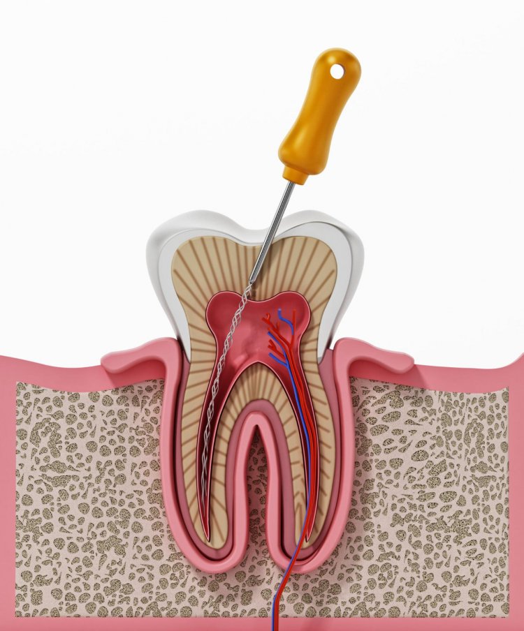 Reviving Oral Health: The Power of Endodontic Intervention