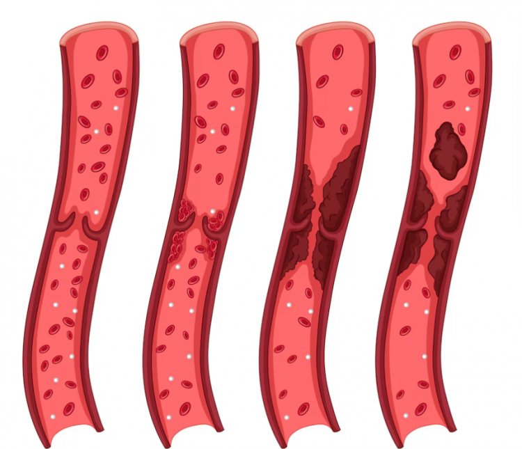 From Diagnosis to Management: Living with Vasculitis