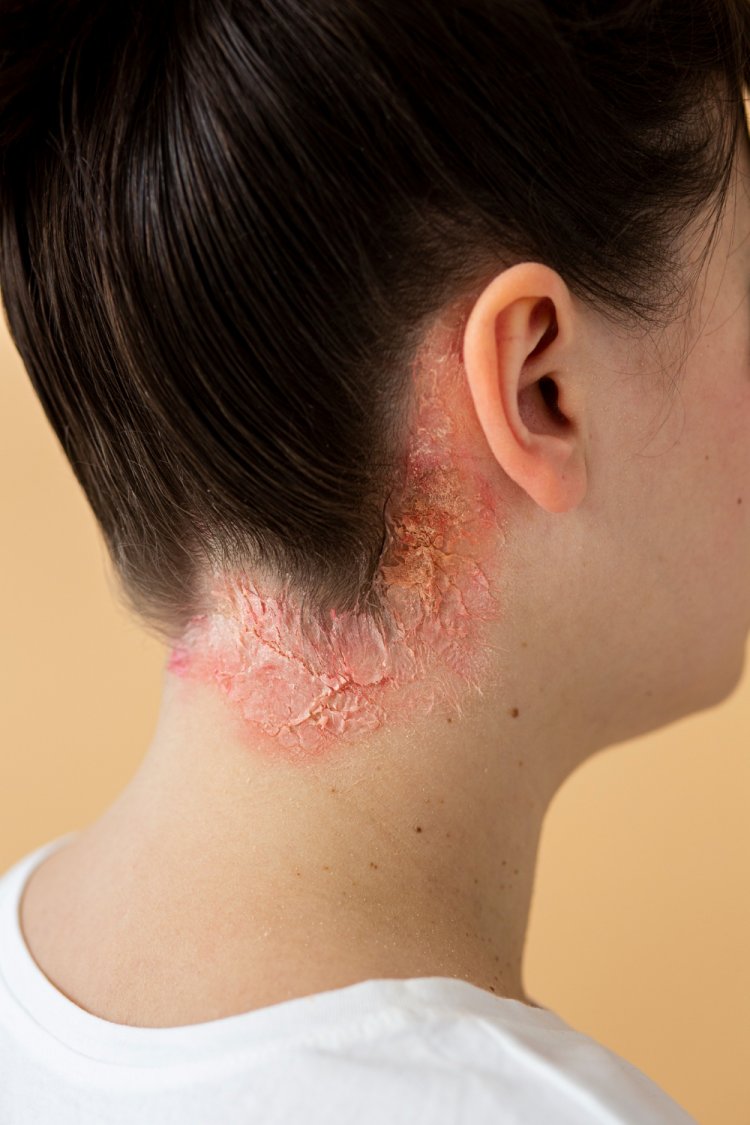 Conquering Seborrheic Dermatitis: Strategies for Clearer, Healthier Skin