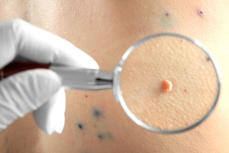 Enhance Your Skin, Safely: The Ins and Outs of Mole Removal