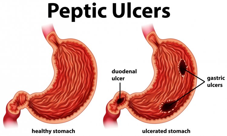 Beyond the Burn: Exploring the Depths of Peptic Ulcer Disease