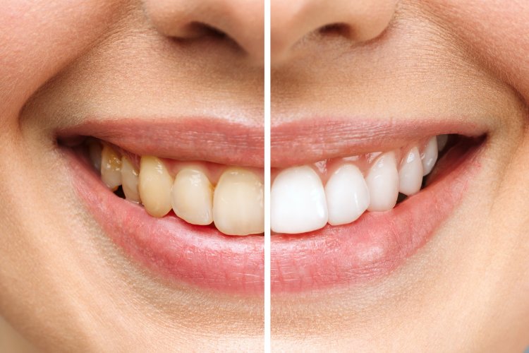 Whiten Your Teeth Safely: Tips and Tricks from Dental Experts