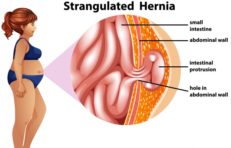 Hernia Alert: Detecting and Defeating Inguinal Hernias