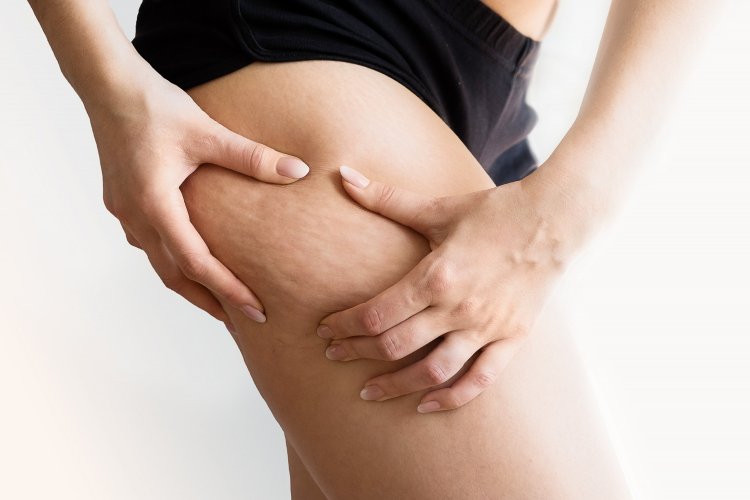 What is Cellulite, Its Causes, and Treatment