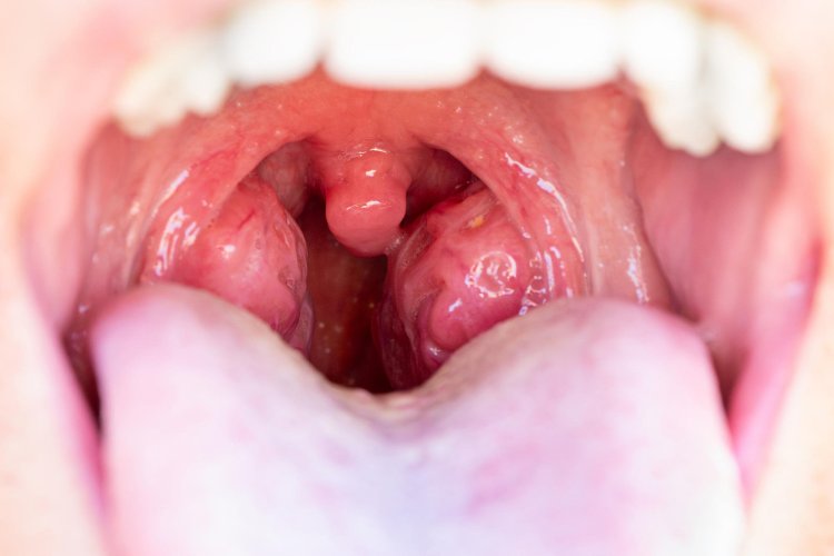 Tonsillectomy: A Comprehensive Overview of Surgical Removal of Tonsils