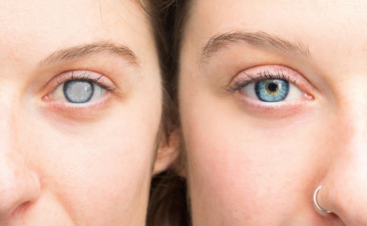 Aging Eyes: The Truth About Cataracts and How to Combat Them