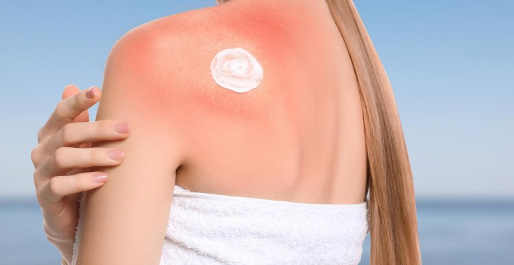 Protect Your Skin: The Sunburn Prevention Guide