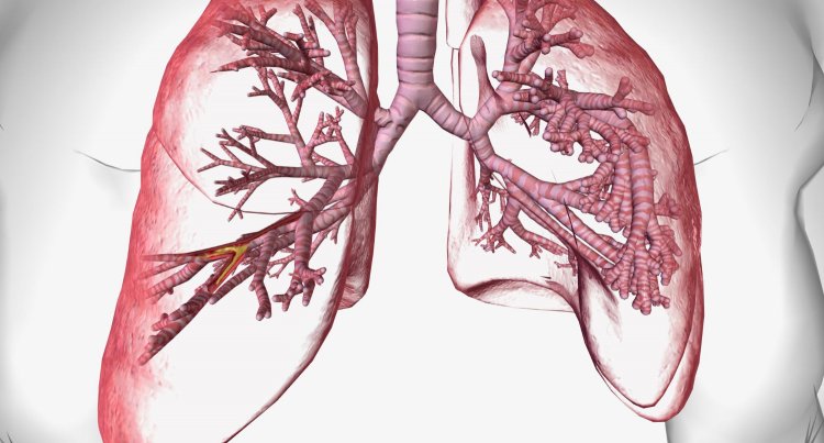 Innovative Therapies for Bronchiectasis: Improving Quality of Life